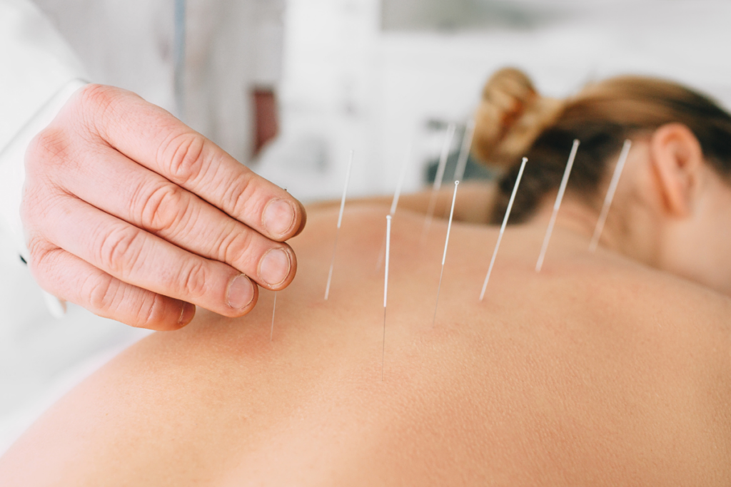 Acupuncture Therapy San Diego at Pacific Bay Recovery